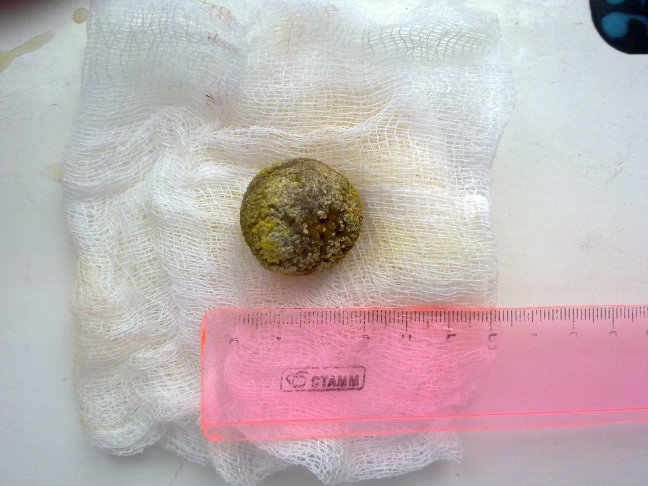 Камни из желчного вышли сами. Камень в жёлчном пузыре 2 см. Камень в жёлчном пузыре 1см. Камень в жёлчном пузыре 16 мм.